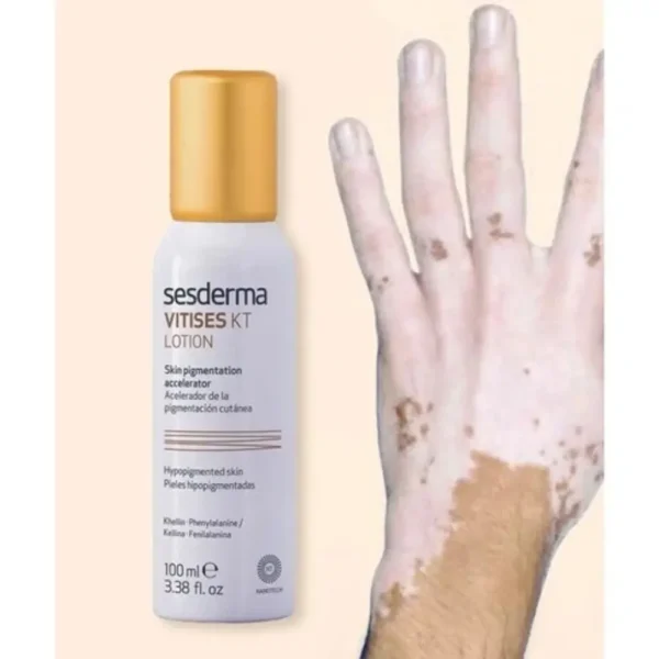 vitises lotion